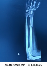 X-ray Forearm Ap Views Finding Fracture Distal Shaft Of Radius.Severe Swelling Of Soft Tissue.Medical Health Concept.