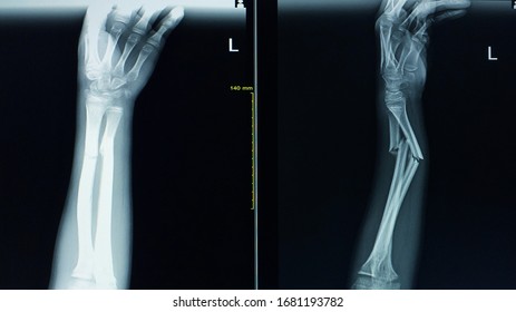 X-ray Forearm (AP,Lateral) View Case Accident Fall Hight Finding Fracture At Left Ulnar And Left Radial Diaphysis With Displacement.Medical Healthcare Concept.