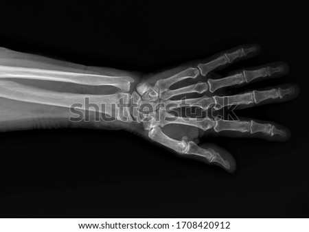 x-ray of the forearm bones with a fractured radius