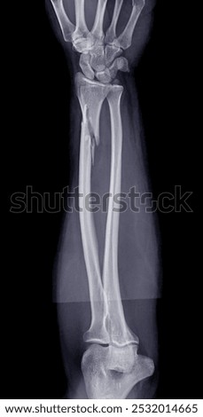 X-ray of the forearm displaying a radius bone fracture, critical for evaluating the extent of the injury and planning treatment.