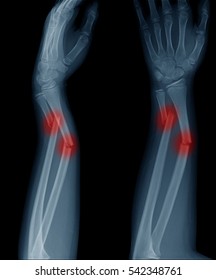 X-ray Forearm Fracture In Child.