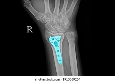 Xray Of A Forearm Of A Patient With Fractured Wrist Bones After Surgery With Plate And Screws Fixation. Orthopedic Trauma. Orthopedic Implants, ORIF Concept.