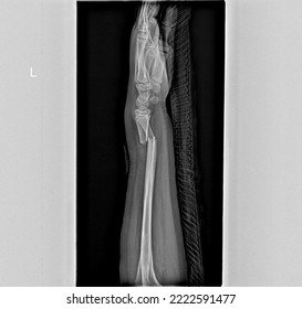 X-Ray forearm Radiograph Showing Radius and Ulna Fractures  - Shutterstock ID 2222591477