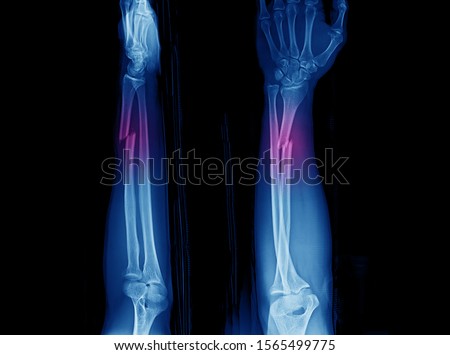 X-ray of forearm and wrist showing closed fracture at distal part of diaphysis of radius with distal radioulnar joint or DRUJ dislocation. The fracture is also called Galeazzi fracture.  