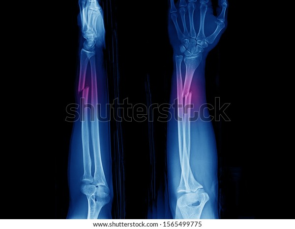 Xray Forearm Wrist Showing Closed Fracture Stock Photo 1565499775 ...