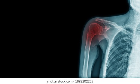 X-ray Fracture Of Acromion Process And Neck Of Humerus Bone