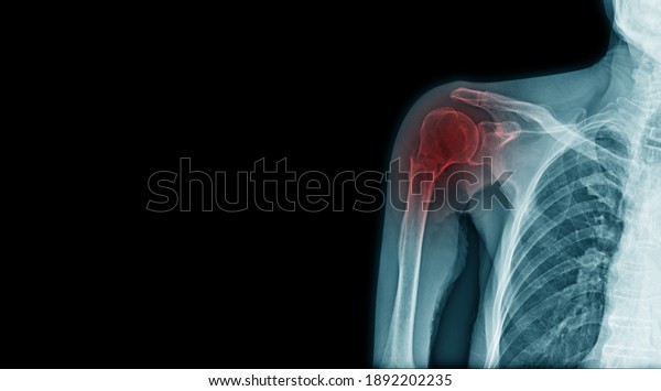 x-ray fracture of acromion process and neck of\
humerus bone