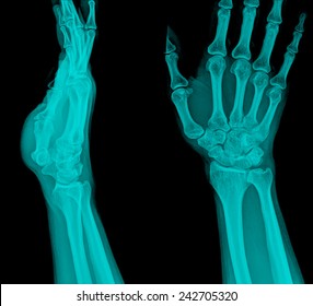 Xray Fracture Distal Radius (Colles' Fracture) (wrist Broken)