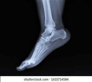 x-ray of a fracture of the inner ankle - Shutterstock ID 1610714584