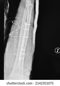 Rayo X de una fractura del hueso del radio del brazo izquierdo, llamada fractura de Galeazzi, fijada con una placa y seis tornillos de titanio, y 22 grapas quirúrgicas para cerrar la incisión