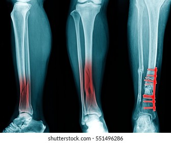 x-ray fracture of tibia, internal fixation tibia bone