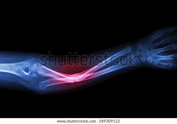 Forearm pain Images - Search Images on Everypixel