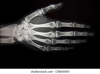 537 Distal radius x ray Images, Stock Photos & Vectors | Shutterstock