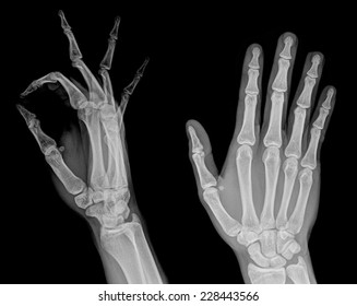 X-Ray Hand - Shutterstock ID 228443566