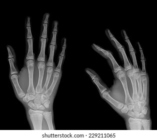 Hand Xray Showing Open Fracture Distal Stock Photo 1584429727 ...