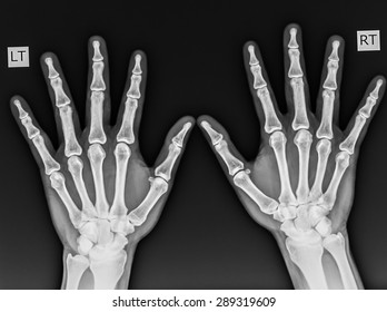 Film Xray Both Hand Ap Show Stock Photo 1096171694 | Shutterstock