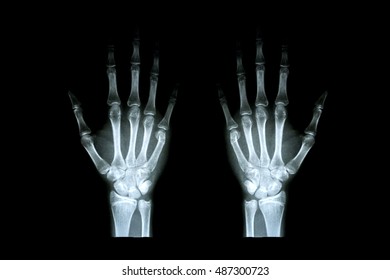 X-Ray Hand. - Shutterstock ID 487300723