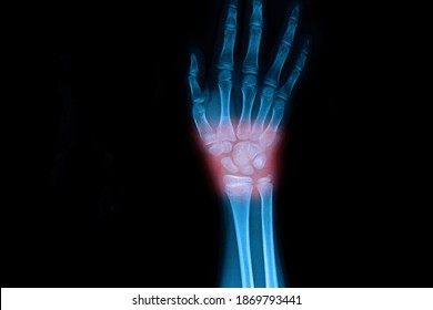 Xray Both Foot Showing Bone Erosion Stock Photo 1417487099 