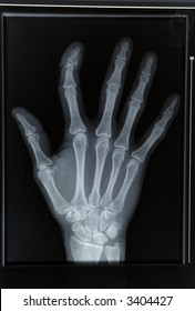 An Xray Of A Hand With Broken Finger