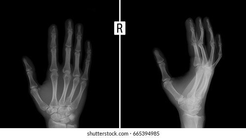 Xray Hand Shows Subperiosteal Fracture Left Stock Photo (Edit Now ...