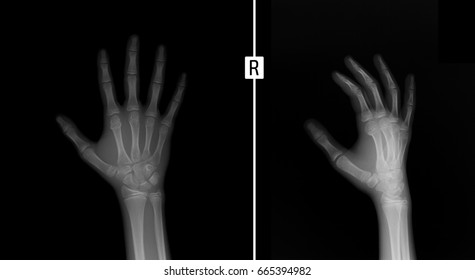 Xray Hand Fracture Head Second Metacarpal Stock Photo 665394982 