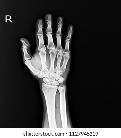 X-ray Hand fracture mid shaft Rt.2nd. metacapal bone soft tissue swelling. - Shutterstock ID 1127945219