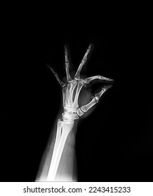 X-ray hand oblique view normal - Shutterstock ID 2243415233