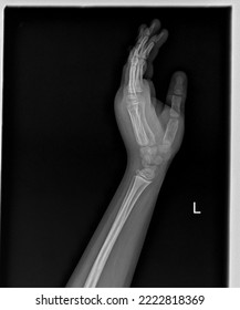X-Ray Hand with proximal Radius Ulna Lateral View  - Shutterstock ID 2222818369