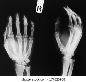 X-ray Of Hand, Right Side