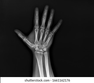 x-ray of the hand and wrist bones - Shutterstock ID 1661162176