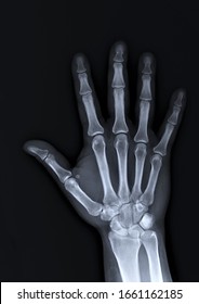 x-ray of the hand and wrist bones - Shutterstock ID 1661162185