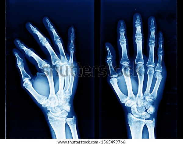 X-ray of hand and wrist showing closed fracture at\
neck of fifth metacarpal bone or boxer fracture. This type of\
fracture can be treated with closed reduction and splinting with\
ulnar gutter slab.