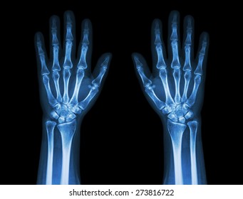 Wrist Xray Images Stock Photos Vectors Shutterstock