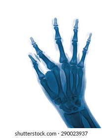 Xray Hands Front View Normal Human Stock Photo 290023937 | Shutterstock