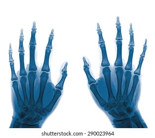 Xray Hands Front View Normal Human Stock Photo 290023964 | Shutterstock