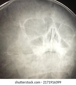 X-ray, Head,brain, Skull, Anatomy,image,bones,medicine,radiology,skeleton,anatomy,human,inside,moon,medical,healthy,broken, Strong,doctor,photo, Examinations,neck, Alien,inside. Blured,blur,body