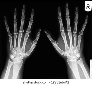 Xray of a healthy 30 year old female, left and right hand