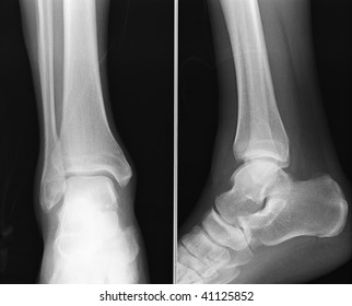 x-ray of a heel