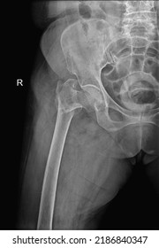 Xray Hip Joint Fracture Ap Radiograph Stock Photo 2186840347 | Shutterstock