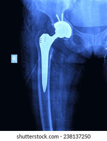 X-ray Of The Hip Prosthesis