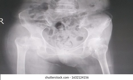 X-ray Hips (AP Views):history A Female Falldow And Pain Hips After X-ray Finding Fracture Of The Femoral Nek.healthcare Concept.