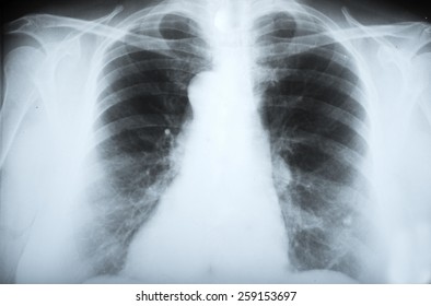 Chest Xray Showing Hyperinflation Lungs Compatible Stock Photo ...