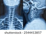 X-ray of the human cervical spine. Early degenerative change at cervical spine. Minimal marginal osteophytes are noted in the cervical vertebrae. 