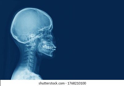 x-ray of human cervical spine and  head skull .The sella turcica looks narmal.Medical image concept.