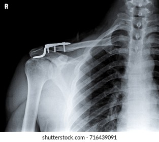 Clavicle Images, Stock Photos & Vectors | Shutterstock