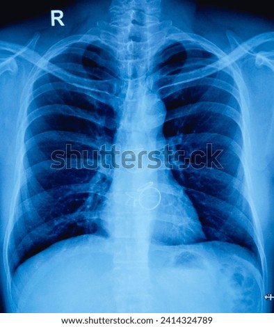 X-ray of the human chest. Post-CABG state, otherwise normal study. Coronary artery bypass graft.