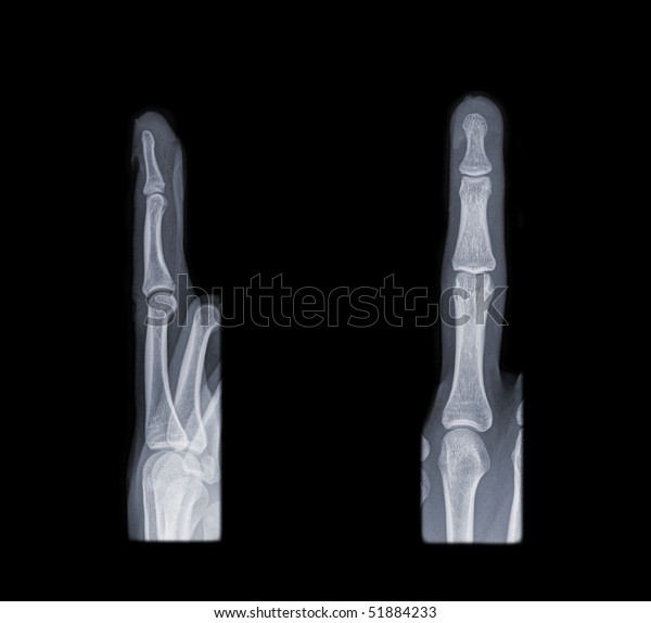 Xray Human Finger Side Front View Stock Photo (Edit Now) 51884233