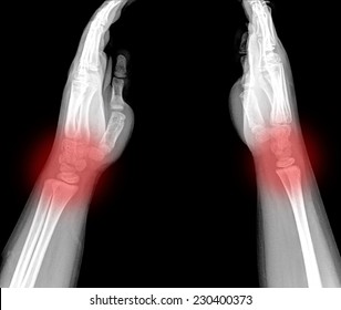 Xray Human Hand Wrist Stock Photo 230400319 | Shutterstock