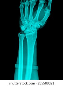 Xray Human Hand Wrist Stock Photo (Edit Now) 235588321