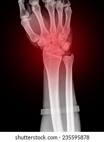 Xray Human Hand Wrist Stock Photo 235595878 